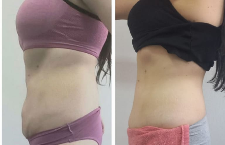 Resultado del tratamiento