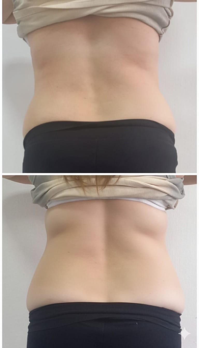 Resultado del tratamiento