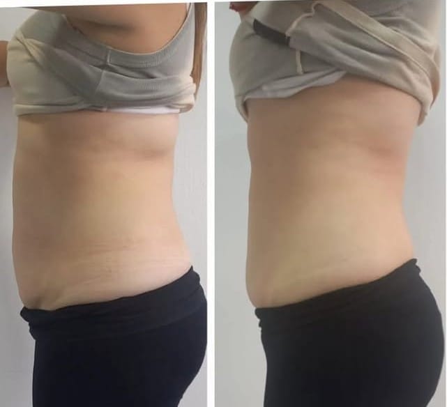 Resultado del tratamiento